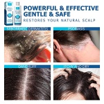 Roycederm Psoriasis Shampoo, Seborrheic Dermatitis Shampoo, Folliculitis Shampoo, Dandruff Shampoo, Scalp Psoriasis Treatment, Seborrheic Dermatitis Treatment, Dry Itchy Scalp Treatment, Dandruff Treatment. - Image 5